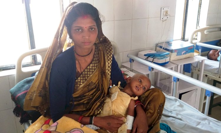 जुड़वा भाईयों समेत 62 बच्चों को भी मिली कुपोषण से निजात